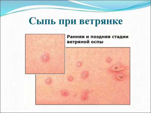 Как распознать и вылечить ветрянку