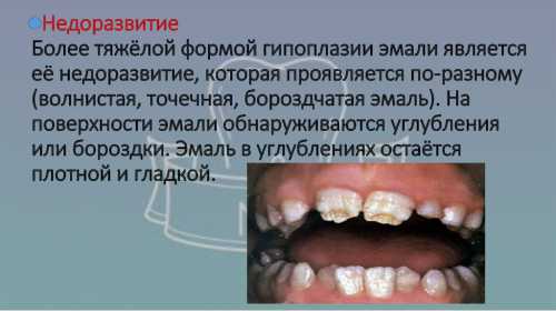 Рентгеновская или ультразвуковая гистеросальпингос копия подтверждает уменьшенные размеры матки, извитость маточных труб, гипоплазию яичников