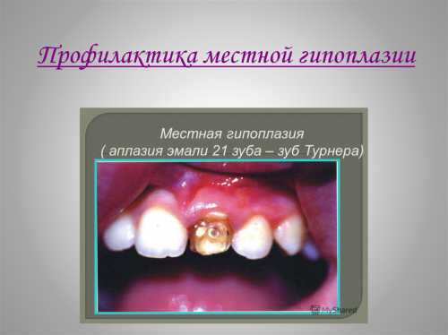 Гипоплазия: симптомы