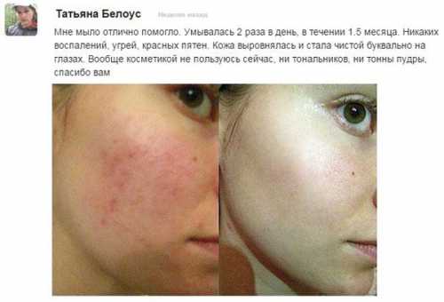 Дегтярное мыло от прыщей