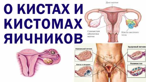 В случае, когда применение такого лечения не приносит эффекта и киста увеличивается или не рассасывается, достигает более см, сопровождается болью, во избежании осложнений в виде разрыва или перекрута, рассматривается вопрос о ее удалении хирургическим путем