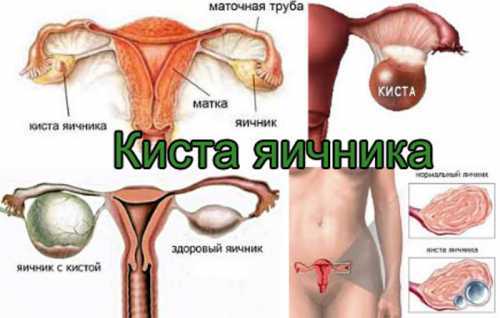 Подробнее о лечении кисты желтого тела правого и левого яичника в нашей статье
