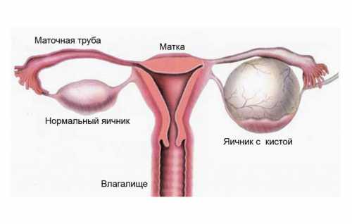 Киста яичника: причины, симптомы и лечение